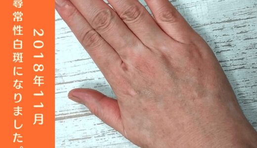 尋常性白斑その後⑦4年かけて手の甲の白斑は、ほぼ治ったよ！